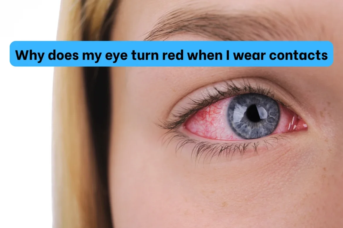 Why does my eye turn red when I wear contacts Why does my eye turn red when I wear contacts